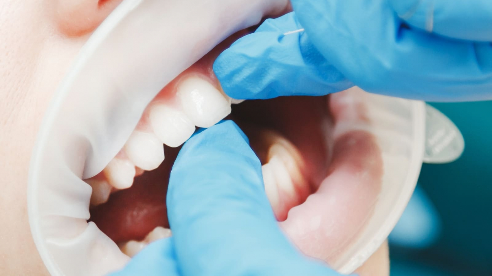 demo-attachment-718-Mask-G2roup-56-1